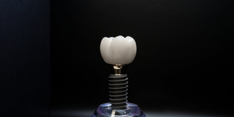 Should You Choose a Dental Implant Over a Bridge