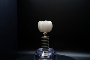 Dental Implant