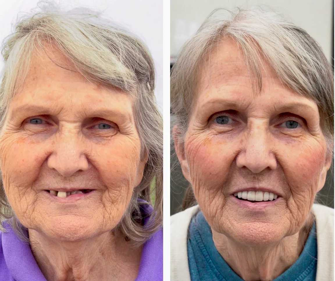 Emma before and after - Olympia Hills Family Dental